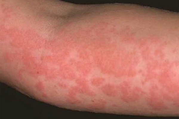 как проявляется аллергия на духи симптомы